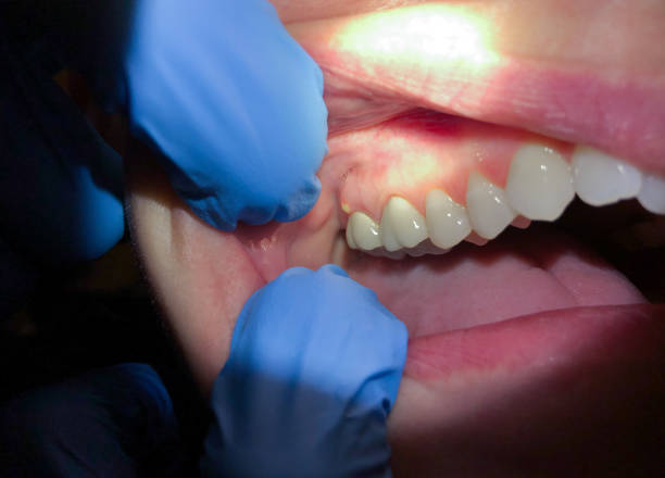 Best Emergency Dental Care for Broken or Chipped Teeth in Reynoldsville, PA