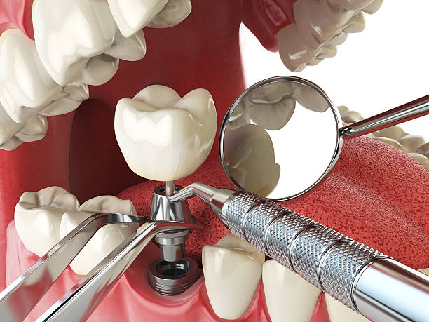 Best Emergency Root Canal Treatment in Reynoldsville, PA